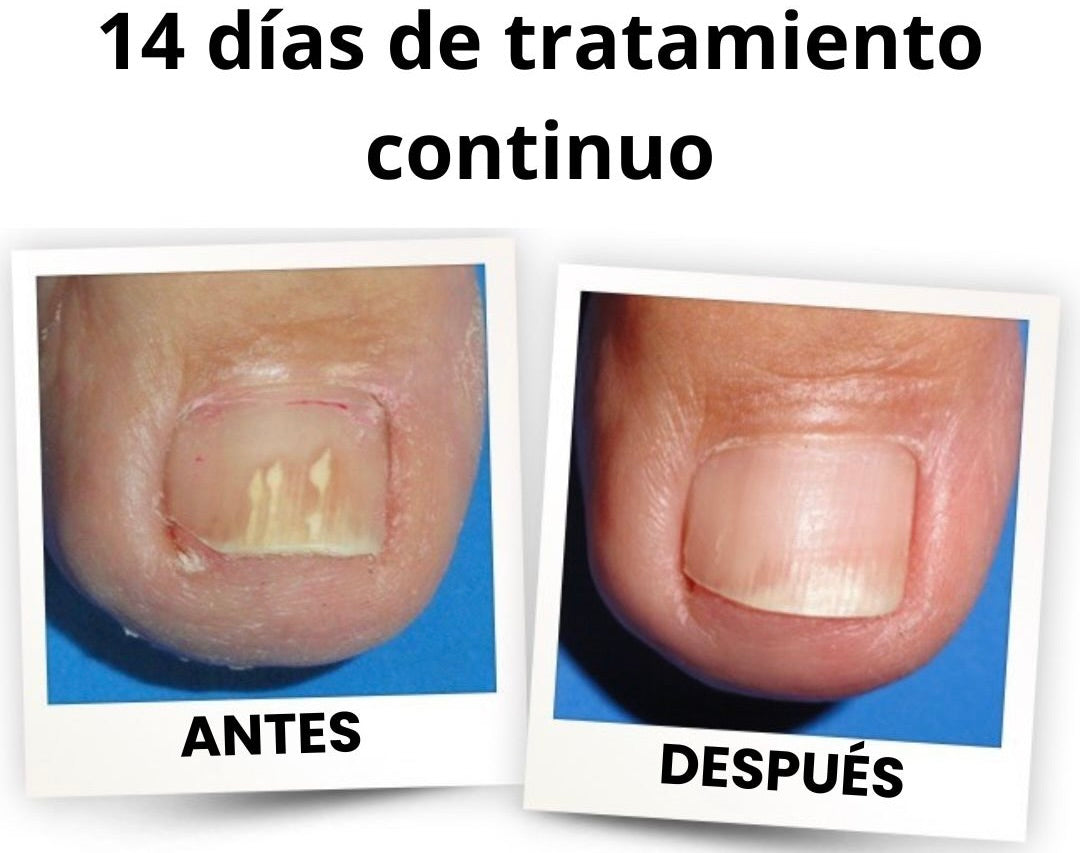 PARCHES ANTI-HONGOS