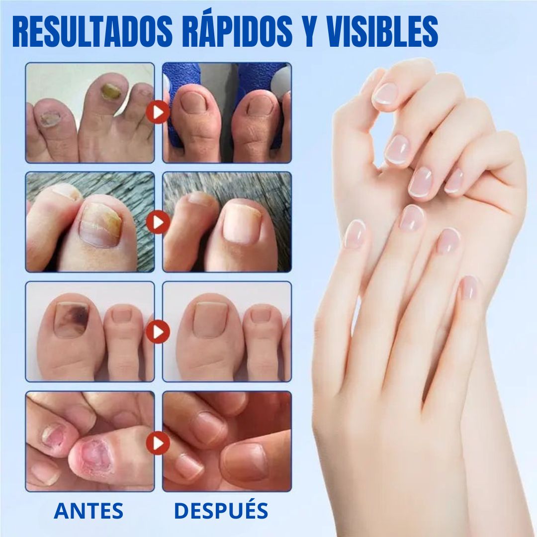 PARCHES ANTI-HONGOS