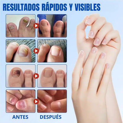 PARCHES ANTI-HONGOS